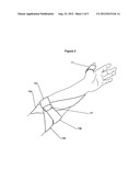 Supinating Arm and Elbow Brace diagram and image