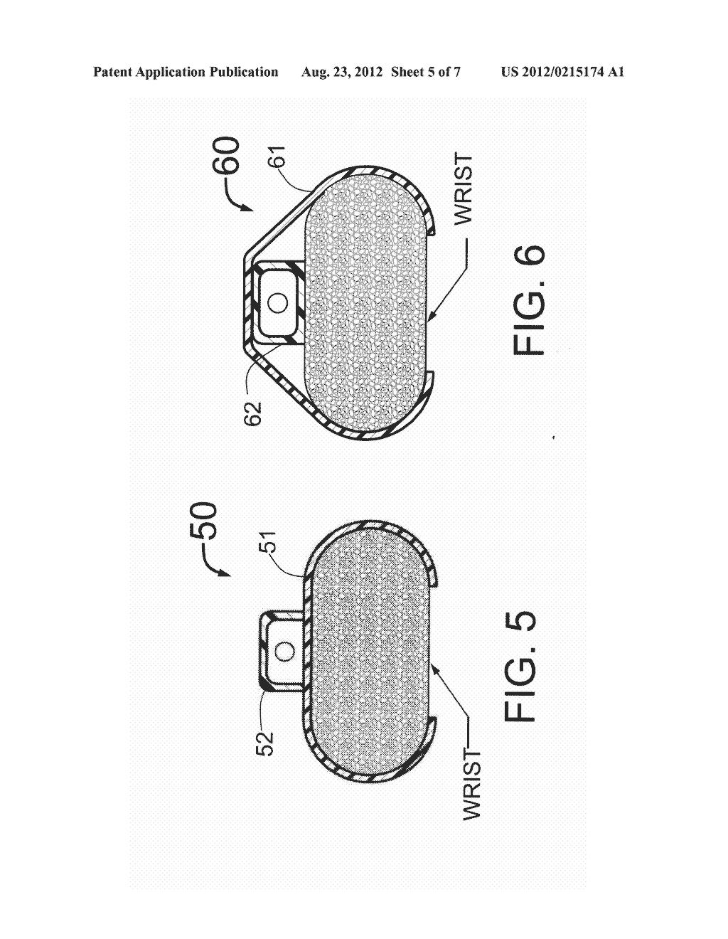 INTRODUCER SHEATH WITH THIN-WALLED SHAFT AND IMPROVED MEANS FOR ATTACHMENT     TO THE SKIN - diagram, schematic, and image 06