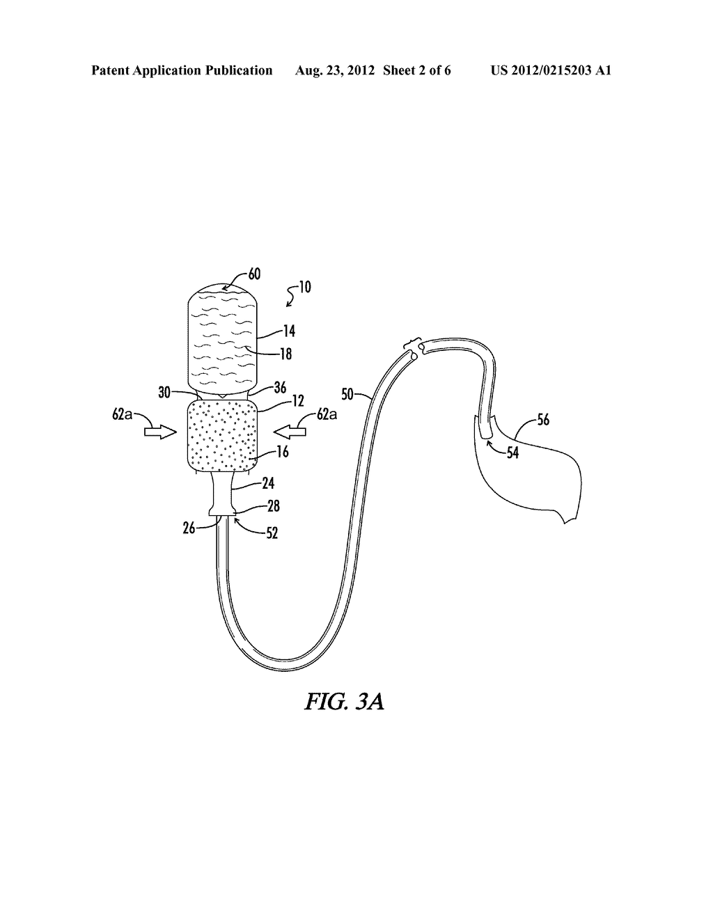 COMPRESSIBLE MULTI-CHAMBER FEEDING TUBE DELIVERY DEVICE AND METHODS - diagram, schematic, and image 03