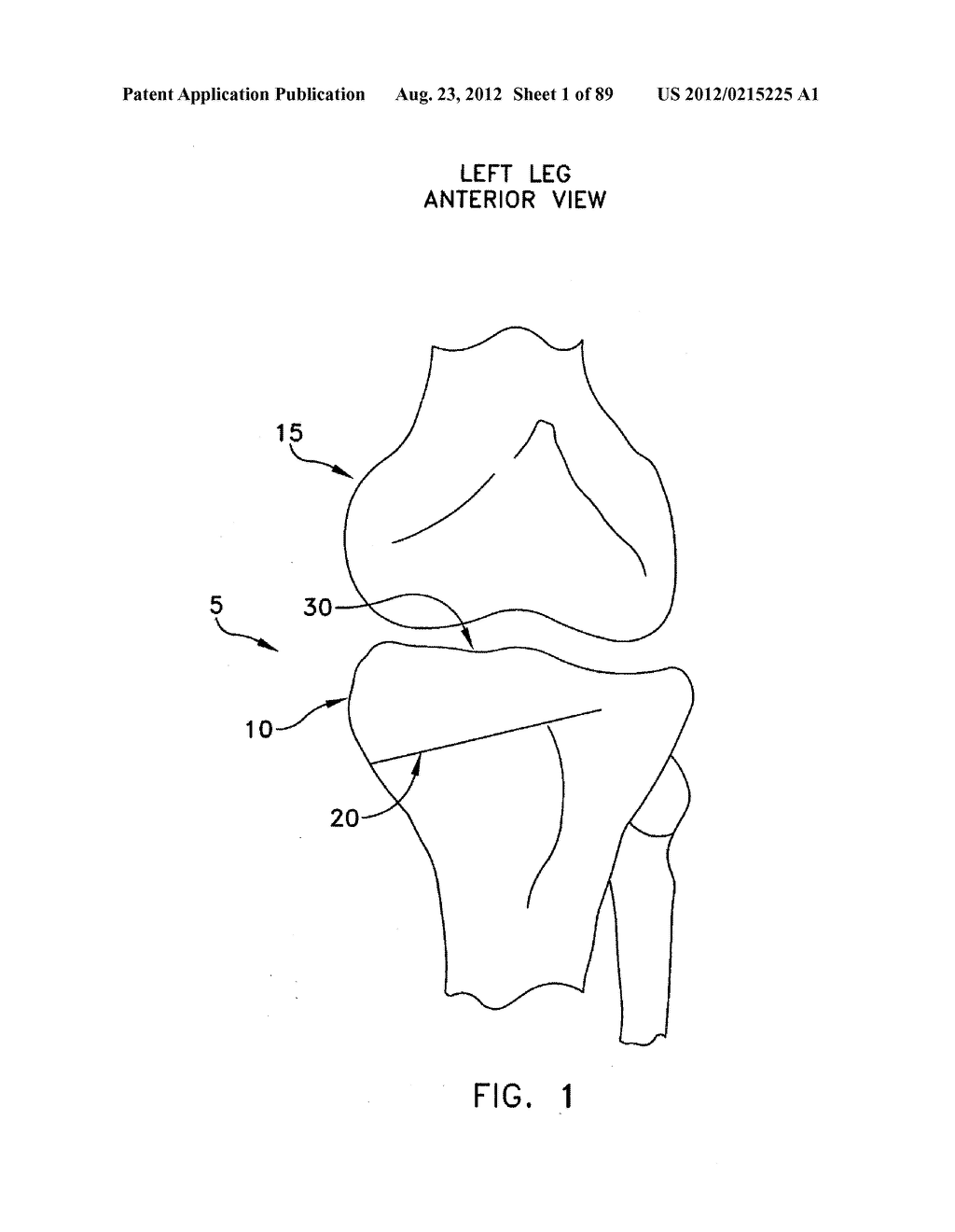 METHOD AND APPARATUS FOR PERFORMING AN OSTEOTOMY IN BONE - diagram, schematic, and image 02