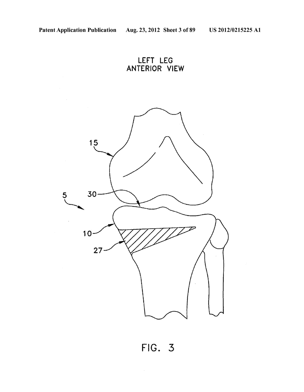 METHOD AND APPARATUS FOR PERFORMING AN OSTEOTOMY IN BONE - diagram, schematic, and image 04