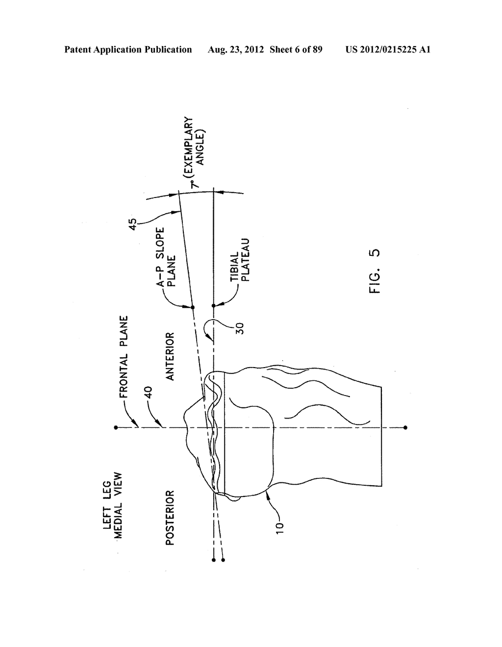 METHOD AND APPARATUS FOR PERFORMING AN OSTEOTOMY IN BONE - diagram, schematic, and image 07