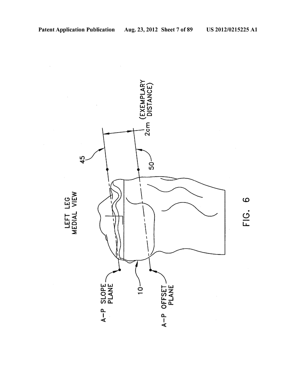 METHOD AND APPARATUS FOR PERFORMING AN OSTEOTOMY IN BONE - diagram, schematic, and image 08