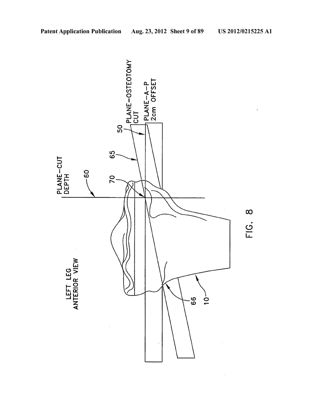 METHOD AND APPARATUS FOR PERFORMING AN OSTEOTOMY IN BONE - diagram, schematic, and image 10