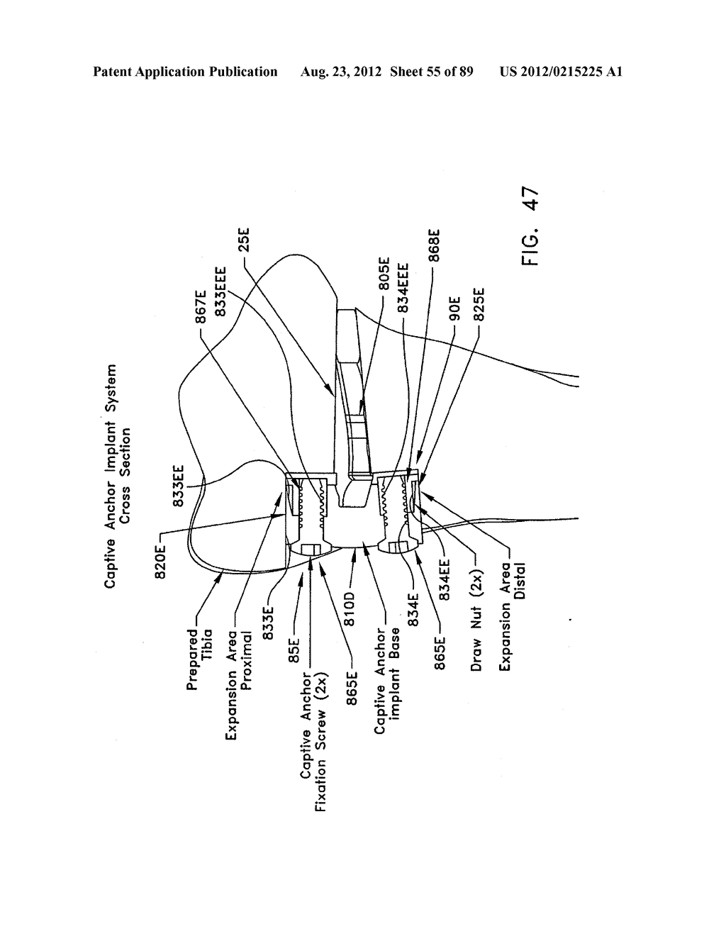 METHOD AND APPARATUS FOR PERFORMING AN OSTEOTOMY IN BONE - diagram, schematic, and image 56