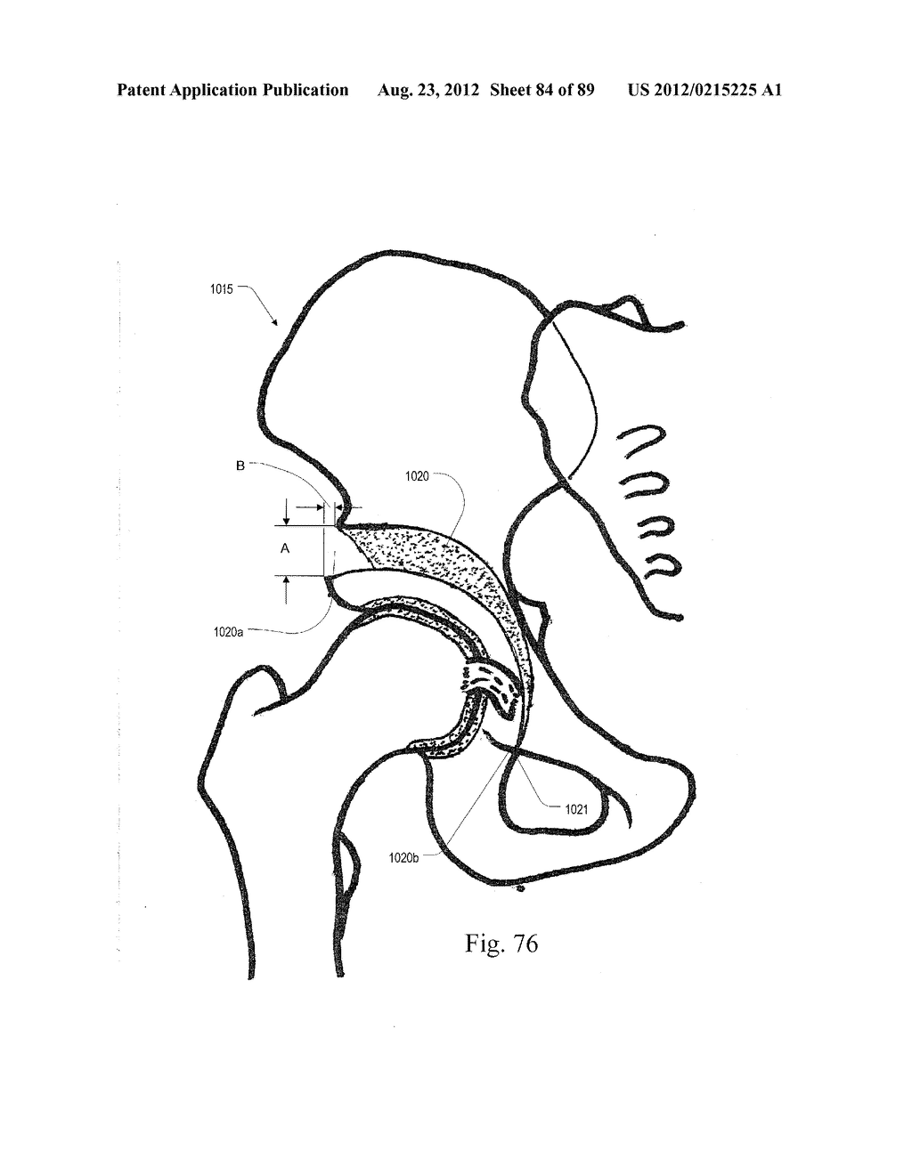 METHOD AND APPARATUS FOR PERFORMING AN OSTEOTOMY IN BONE - diagram, schematic, and image 85