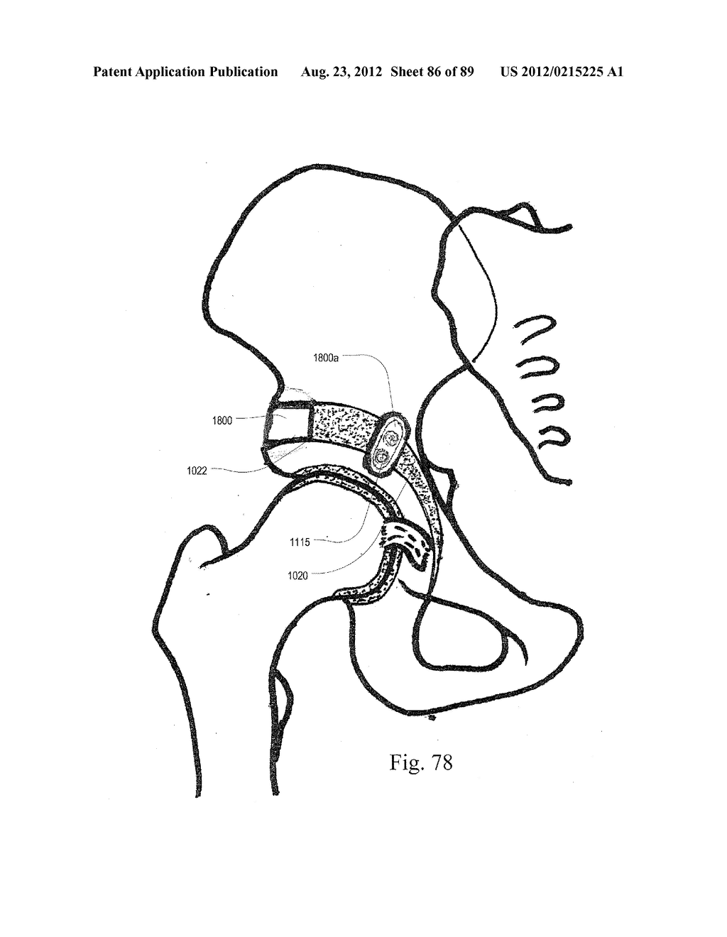 METHOD AND APPARATUS FOR PERFORMING AN OSTEOTOMY IN BONE - diagram, schematic, and image 87