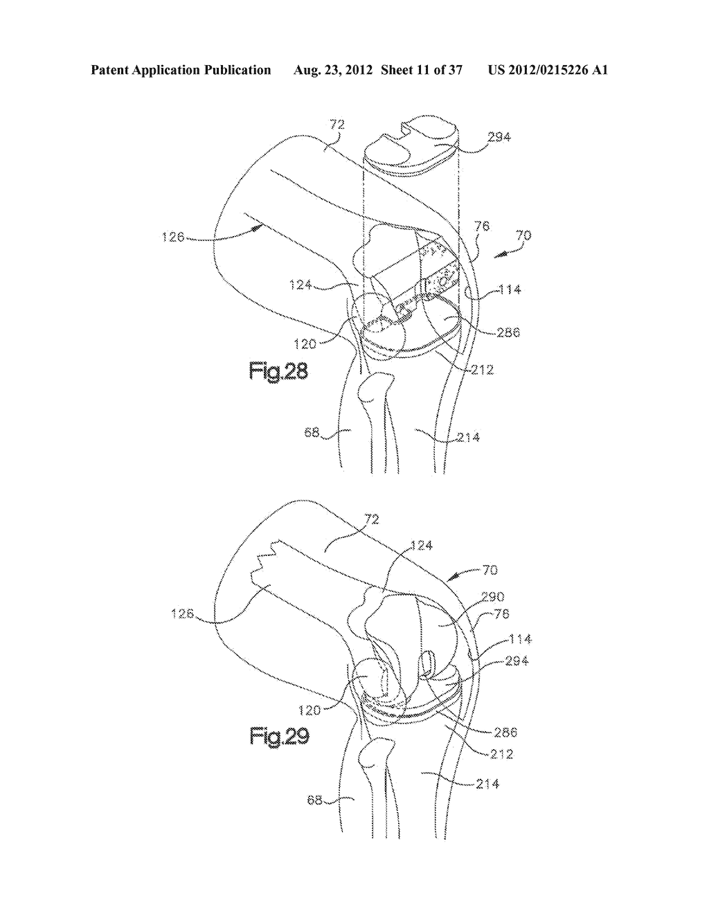 METHODS FOR USING A PATIENT SPECIFIC ALIGNMENT DEVICE - diagram, schematic, and image 12