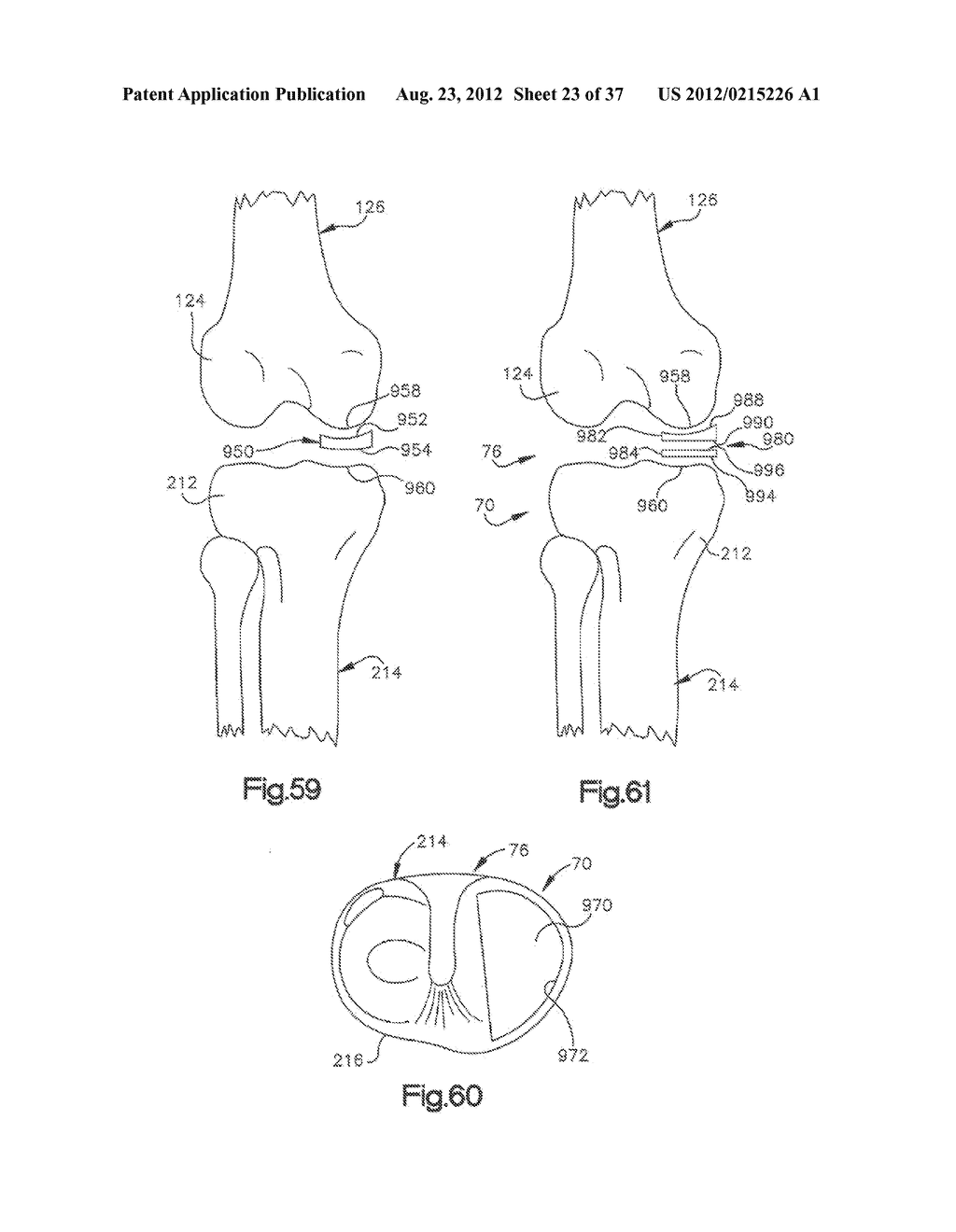 METHODS FOR USING A PATIENT SPECIFIC ALIGNMENT DEVICE - diagram, schematic, and image 24