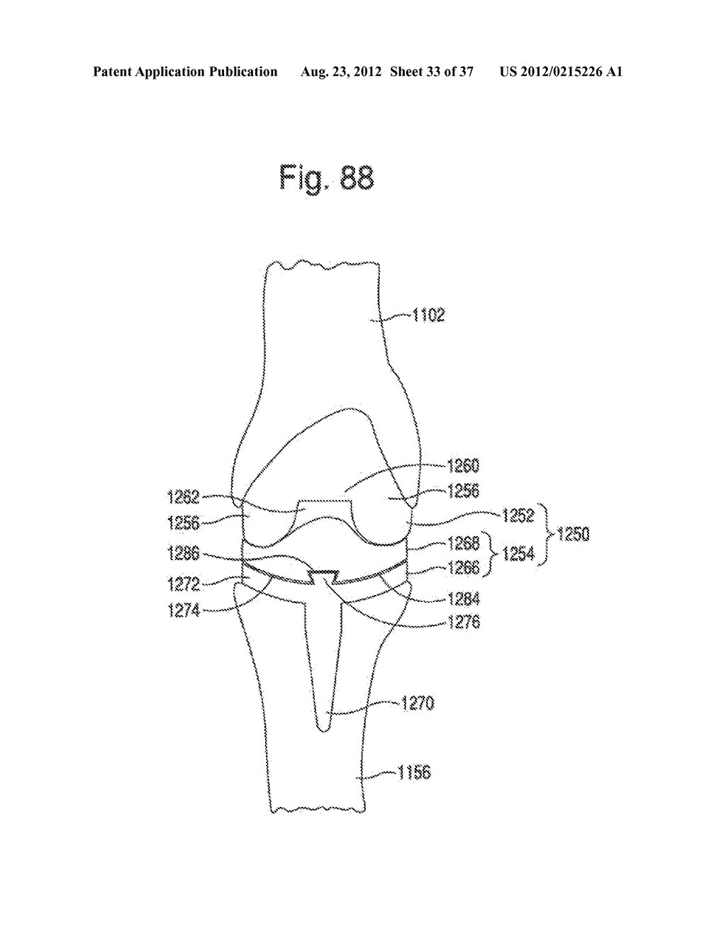 METHODS FOR USING A PATIENT SPECIFIC ALIGNMENT DEVICE - diagram, schematic, and image 34