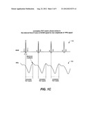 IMPLANTABLE SYSTEMS AND METHODS FOR USE THEREWITH FOR MONITORING AND     MODIFYING ARTERIAL BLOOD PRESSURE WITHOUT REQUIRING AN INTRAVASCULAR     PRESSURE TRANSDUCER diagram and image