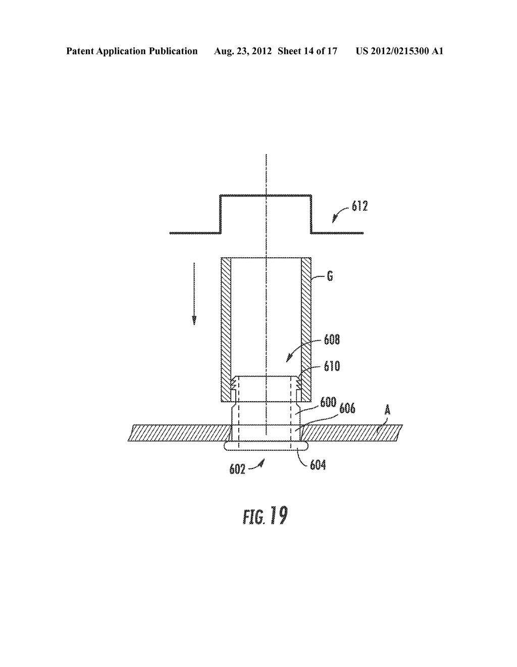 METHOD AND APPARATUS FOR BYPASS GRAFT - diagram, schematic, and image 15