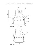 REPLACEMENT HEART VALVE AND METHOD diagram and image