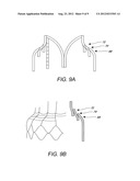 REPLACEMENT HEART VALVE AND METHOD diagram and image