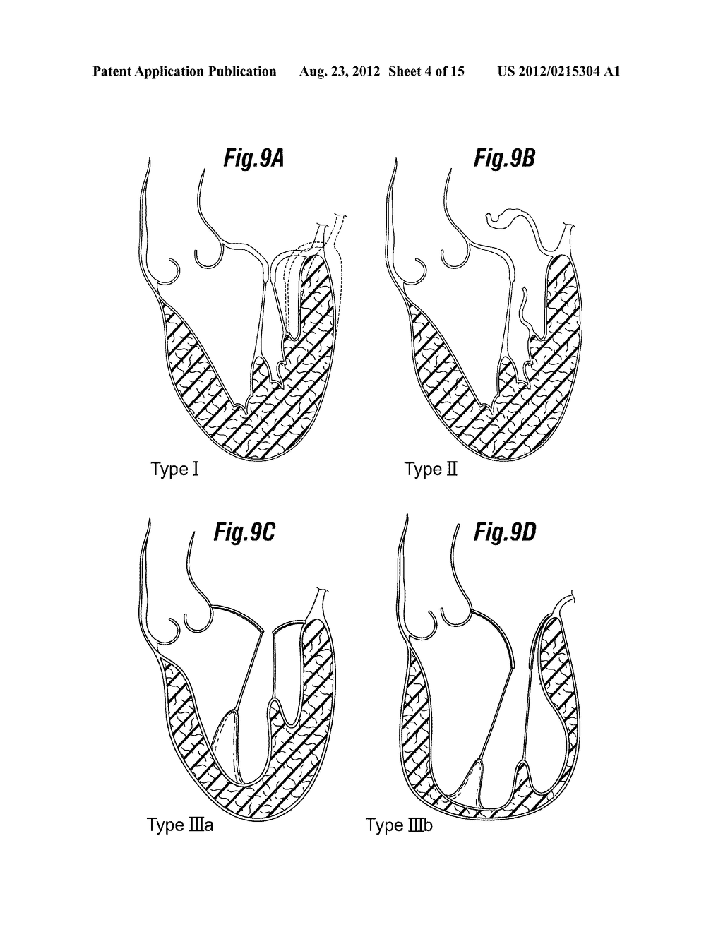 DEGENERATIVE VALVULAR DISEASE SPECIFIC ANNULOPLASTY RING SETS - diagram, schematic, and image 05