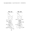 BIOABSORBABLE MULTILAYER NASAL VALVE SPREADER GRAFT diagram and image