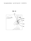 BIOABSORBABLE MULTILAYER NASAL VALVE SPREADER GRAFT diagram and image