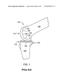 ARTHROPLASTY SHIM diagram and image