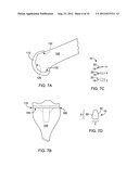 ARTHROPLASTY SHIM diagram and image