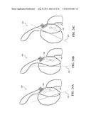 PATIENT INTERFACE WITH AN ADJUSTABLE CUSHION diagram and image