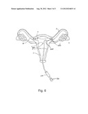 CONSTANT RATE DELIVERY DEVICE diagram and image