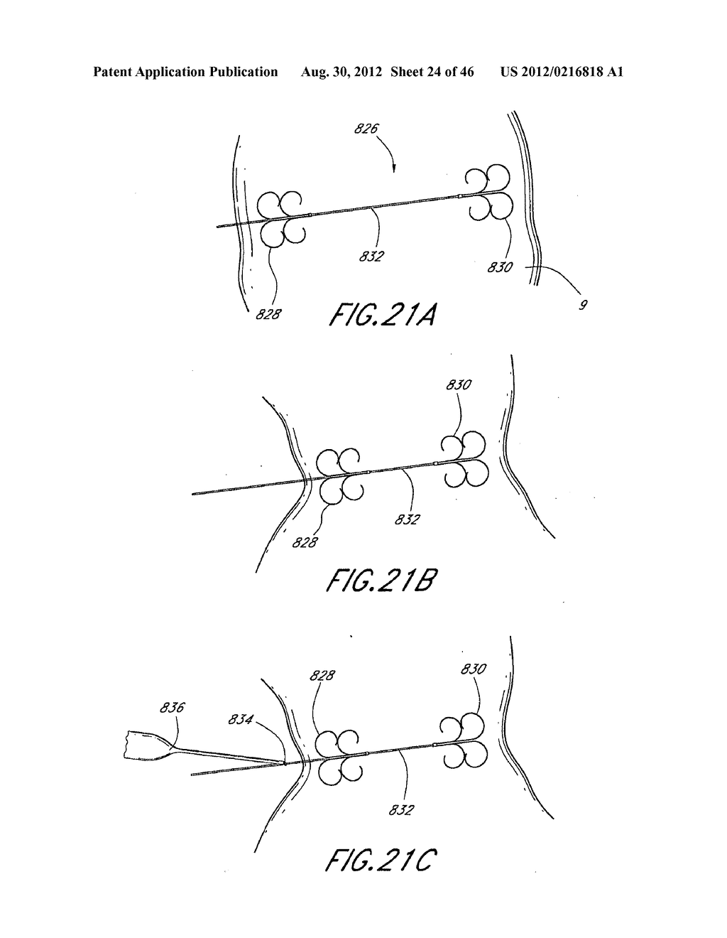 GLASSOPLASTY USING TISSUE ANCHOR GLOSSOPEXY WITH VOLUMETRIC TONGUE     REDUCTION - diagram, schematic, and image 25