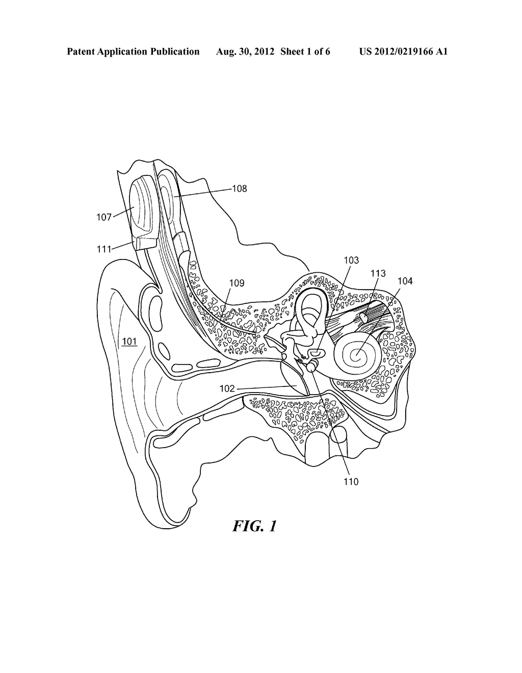 MRI Safe Actuator for Implantable Floating Mass Transducer - diagram, schematic, and image 02