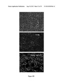 COMPOSTIONS DESIGNED FOR THE INHIBITION AND/OR BLOCKING OF THE     EPITHELIAL/MESENCHYMAL TRANSITION diagram and image