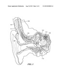 Middle Ear Implant for Otosclerosis diagram and image