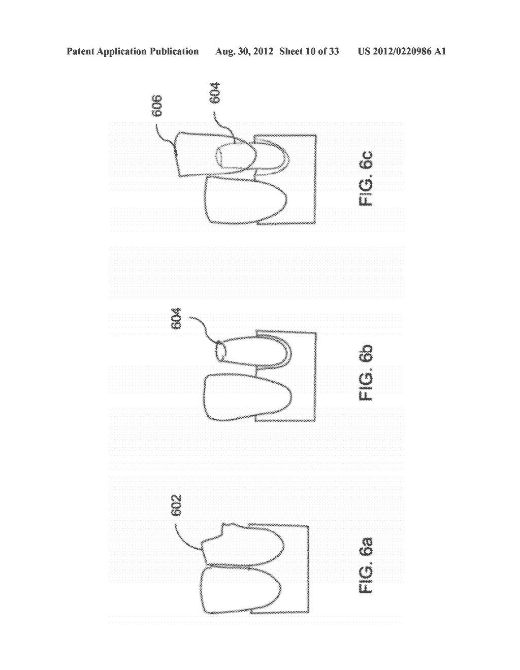 DEVICES AND METHODS FOR INTRAORAL CONTROLLED DRUG RELEASE - diagram, schematic, and image 11