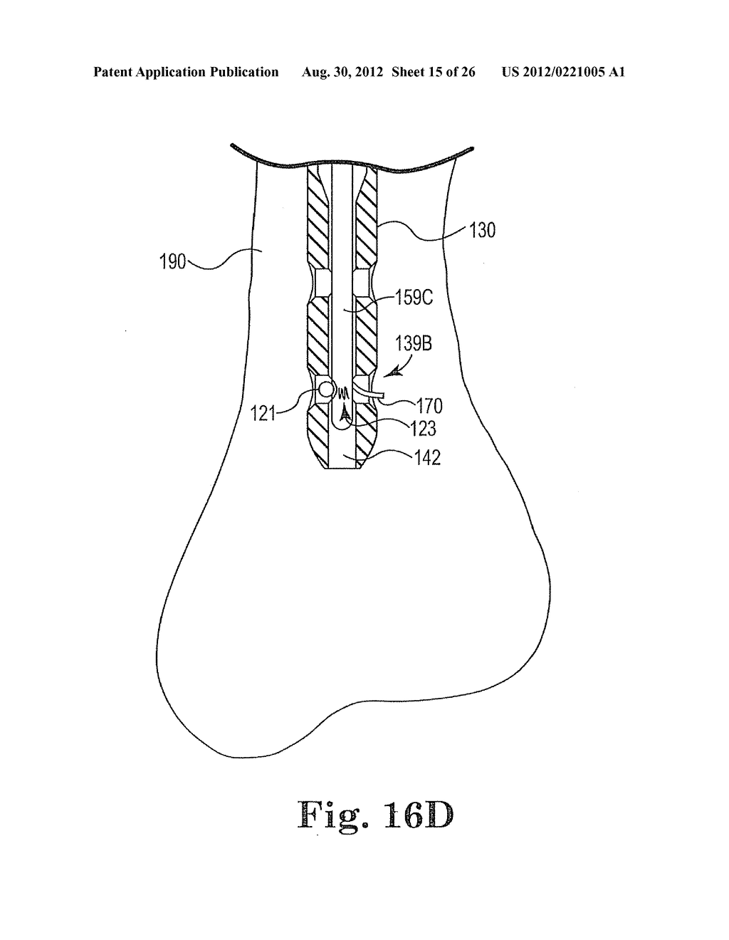 INTERMEDULLARY SYSTEM AND METHOD - diagram, schematic, and image 16