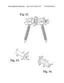 Soft stabilization assemblies with pretensioned cords diagram and image