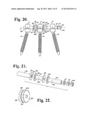 Soft stabilization assemblies with pretensioned cords diagram and image