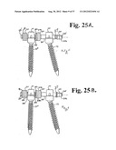 Soft stabilization assemblies with pretensioned cords diagram and image