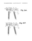 Soft stabilization assemblies with pretensioned cords diagram and image