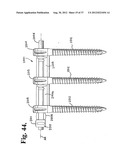 Soft stabilization assemblies with pretensioned cords diagram and image