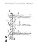 Soft stabilization assemblies with pretensioned cords diagram and image