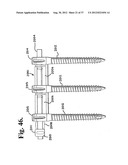 Soft stabilization assemblies with pretensioned cords diagram and image