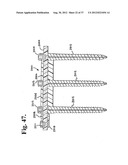 Soft stabilization assemblies with pretensioned cords diagram and image