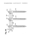 Soft stabilization assemblies with pretensioned cords diagram and image