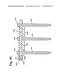 Soft stabilization assemblies with pretensioned cords diagram and image