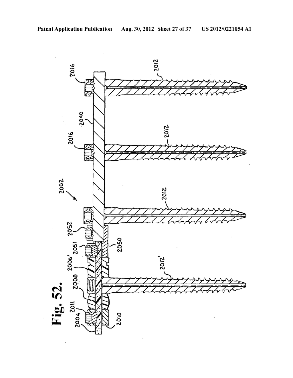 Soft stabilization assemblies with pretensioned cords - diagram, schematic, and image 28