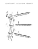 Soft stabilization assemblies with pretensioned cords diagram and image