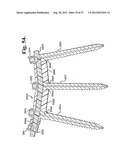 Soft stabilization assemblies with pretensioned cords diagram and image