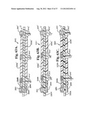 Soft stabilization assemblies with pretensioned cords diagram and image