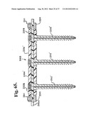 Soft stabilization assemblies with pretensioned cords diagram and image