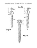 Soft stabilization assemblies with pretensioned cords diagram and image