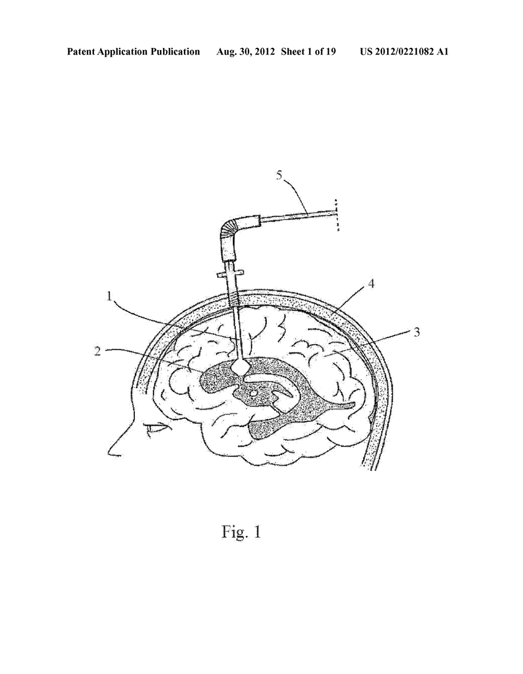 Central Nervous System Treatment Device and Methodology - diagram, schematic, and image 02