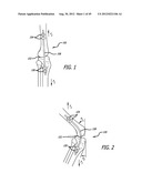 Extra-Articular Implantable Load Sharing Systems diagram and image