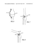 Extra-Articular Implantable Load Sharing Systems diagram and image